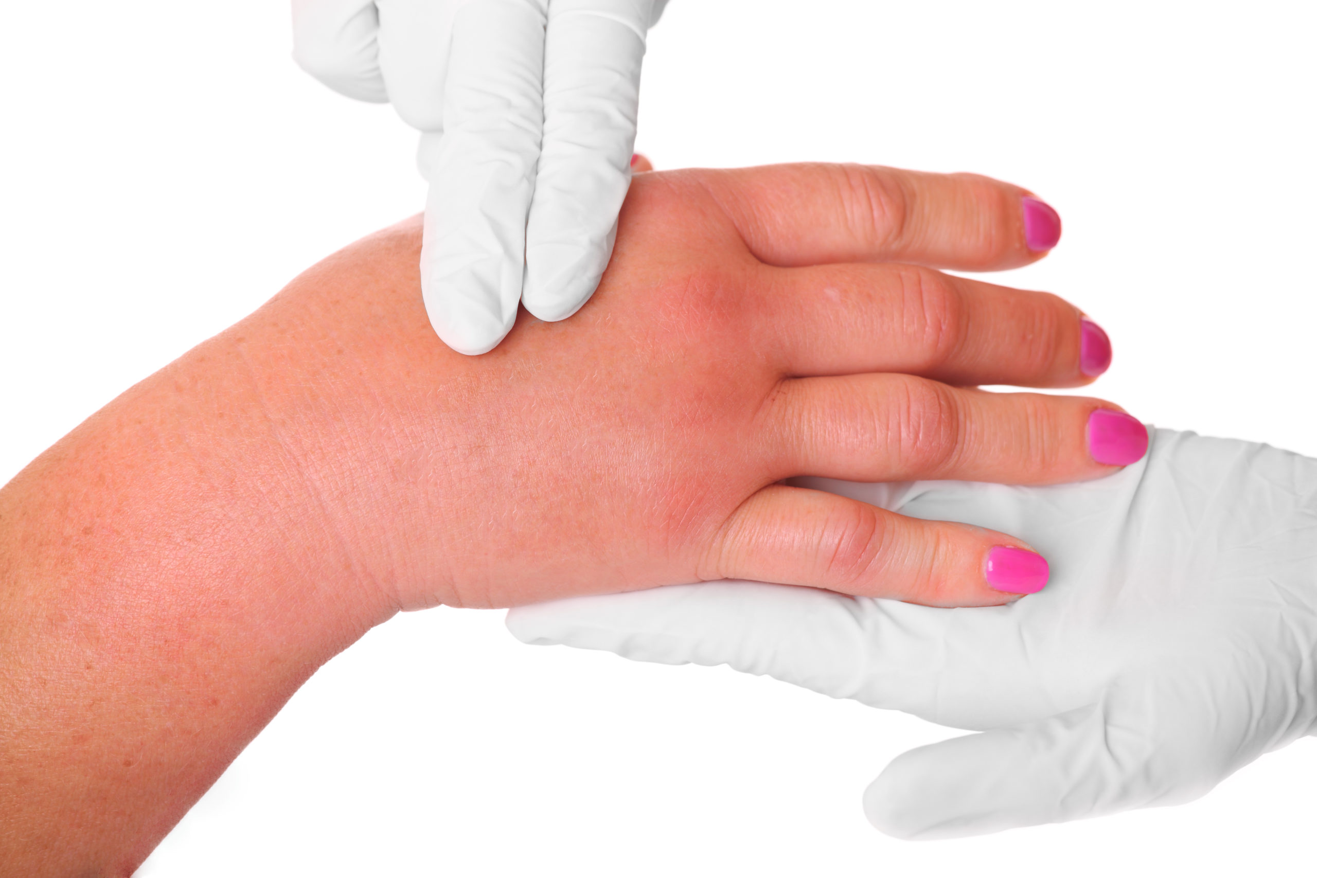 Image of a swollen hand being palpated by someone in white gloves