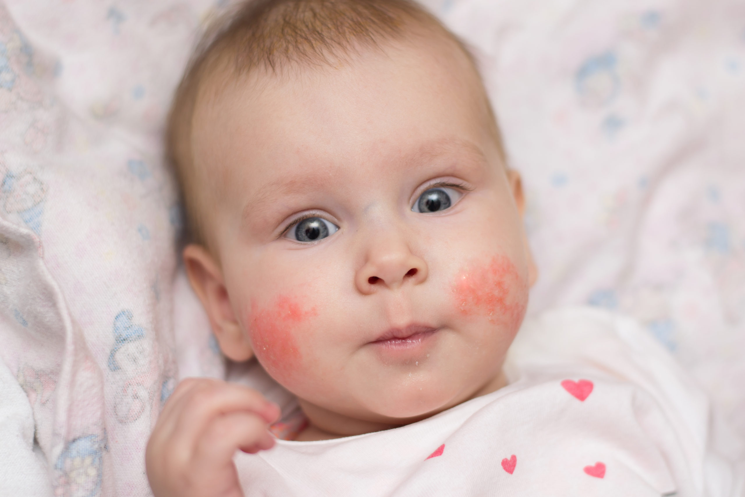 Image of a baby with dry/scaly rash on her cheeks