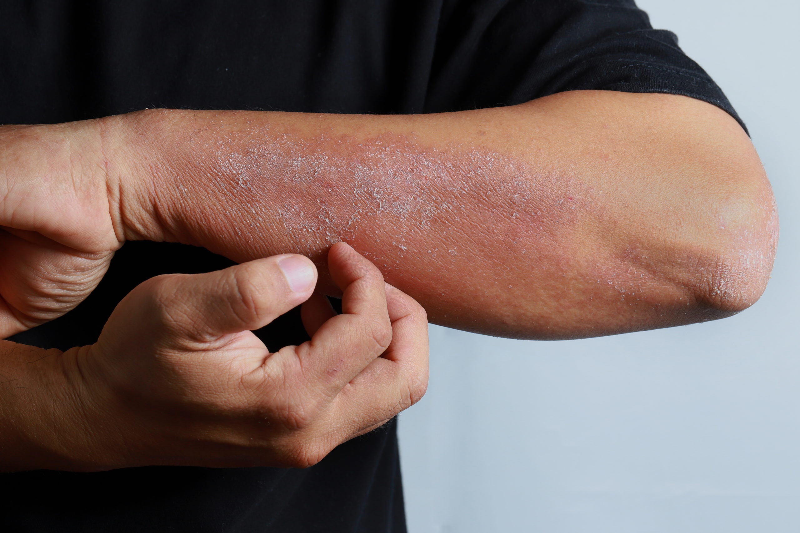 Image of a man scratching his forearm where there is a red/purple dry/scaly rash present