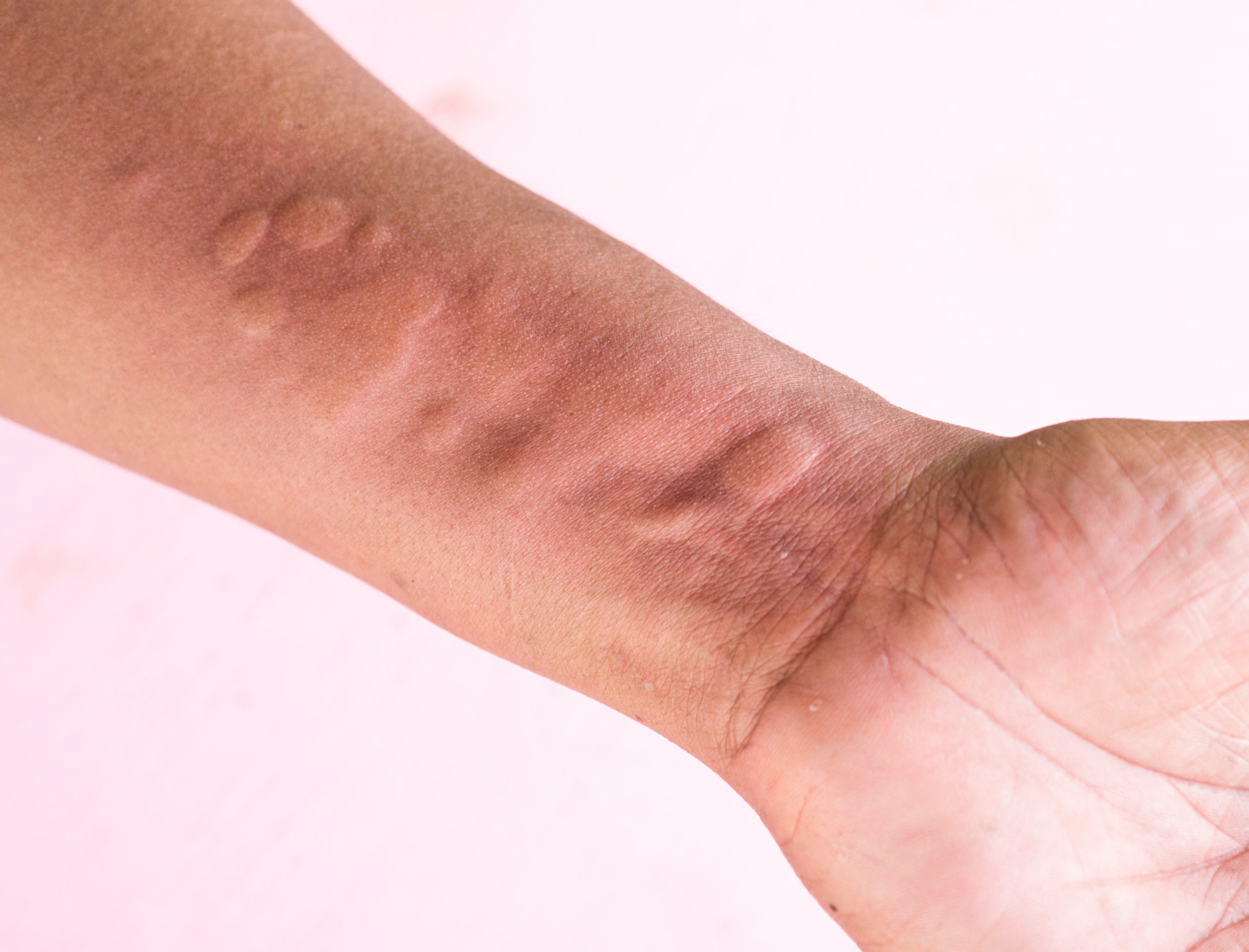 Image of a forearm with red bumps and flat welts